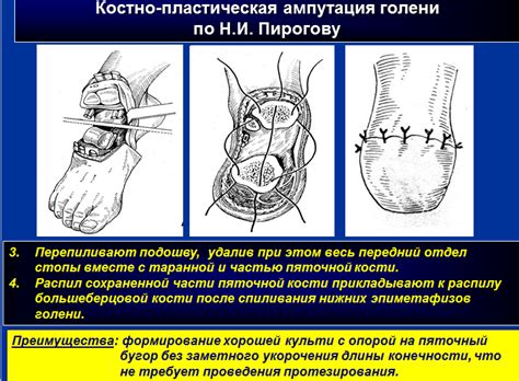 ампути|Ампутация конечностей: виды, показания и реабилитация。